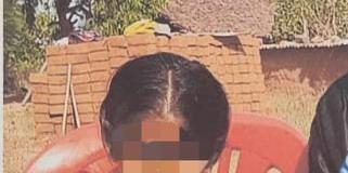 पत्थर शरीर वाली बच्ची के उपचार को लेकर बाल आयोग सक्रिय