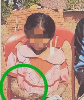 पत्थर शरीर वाली बच्ची के उपचार को लेकर बाल आयोग सक्रिय